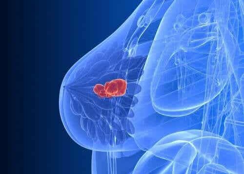 Afbeelding van borstkanker