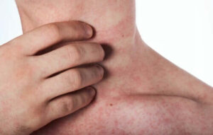 Verschillende soorten antihistaminica en de toepassingen