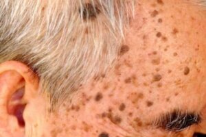 Behandelingen voor seborroïsche keratose