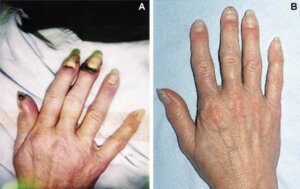 De ziekte van Buerger: alles wat je moet weten