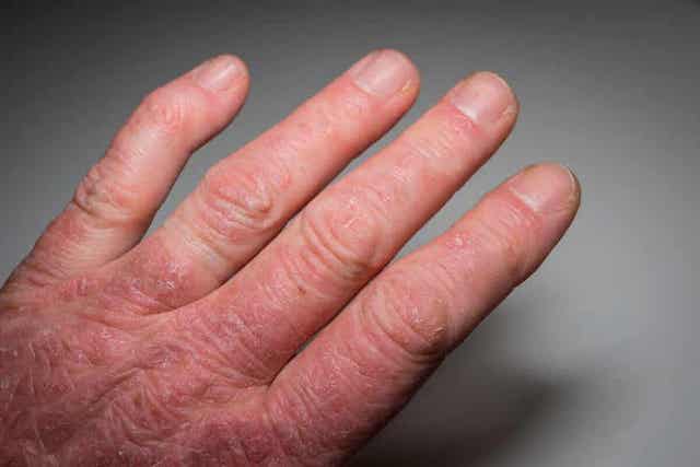 Het fenomeen van Raynaud door lupus