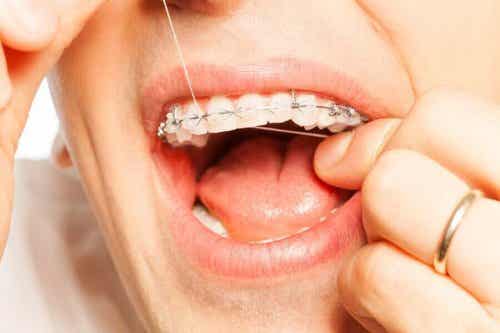 8 verzorgingstips voor mensen met een beugel zoals flossen