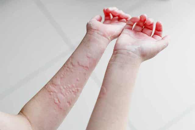 Hebben gluten invloed op huidaandoeningen zoals urticaria