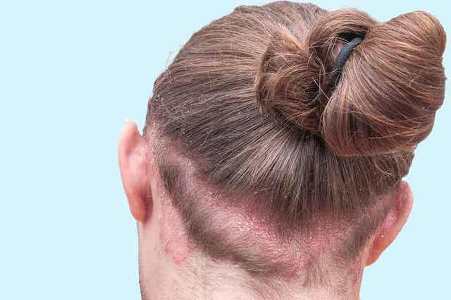 Seborroïsch eczeem is een inflammatoire huidaandoening die roos in de wenkbrauwen kan veroorzaken