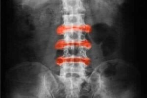 Wereld Spondyloartritis Dag: leer er alles over