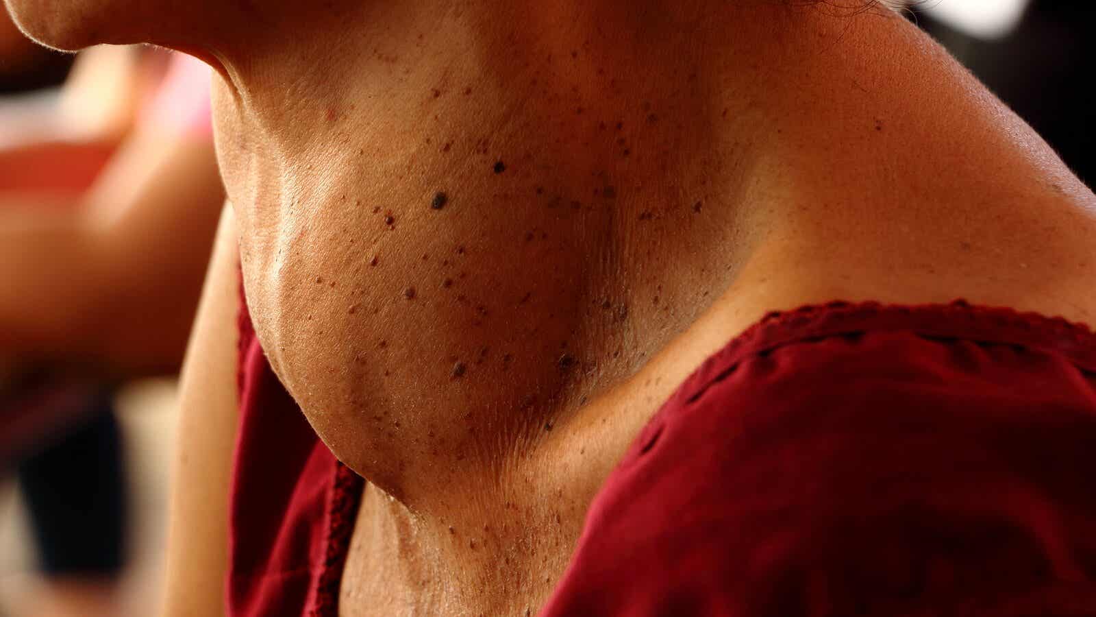 Iemand met een struma