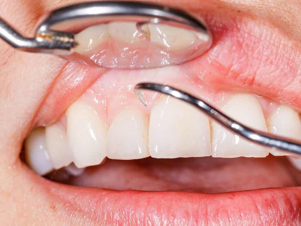 Tandarts haalt tandplak weg