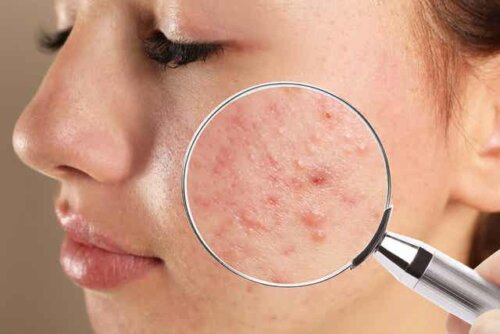 Een vrouw met acne