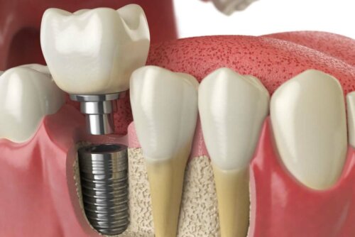 Prothetische tandheelkundige implantaten
