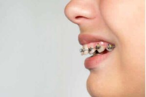 Wat is een overbeet en hoe kun je het behandelen?