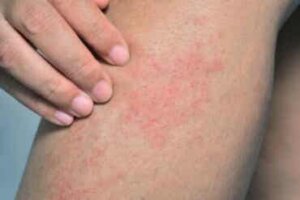 Zwemmersjeuk: oorzaken, symptomen en behandelingen