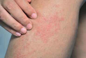 Zwemmersjeuk: oorzaken, symptomen en behandelingen