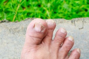 5 soorten huidschimmel en hoe je ze kunt herkennen