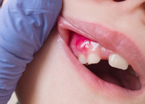 Wat is een tandheelkundige fistel en hoe kan hij behandeld worden?