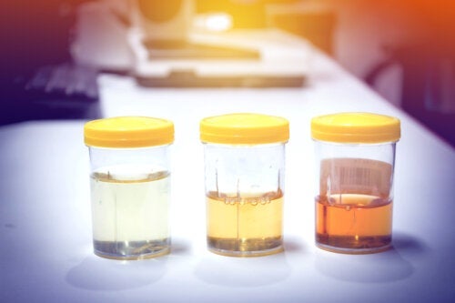 Donkere of troebele urine: 11 mogelijke oorzaken en behandelingen