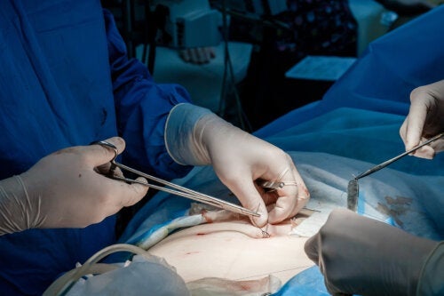 Een huidtransplantatie: wanneer wordt het gedaan?