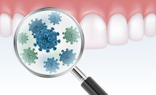 Alles wat je moet weten over bacteriële tandplaque