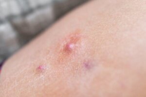 Waarom is het slecht om hidradenitis suppurativa te laten barsten?