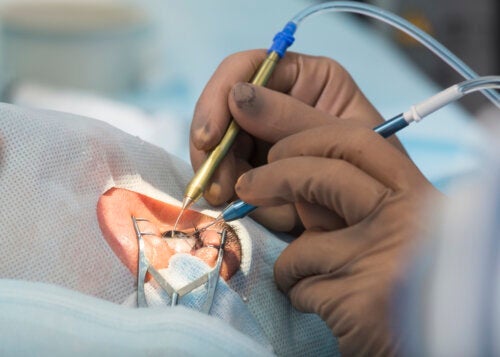 8 mogelijke problemen na een cataractoperatie