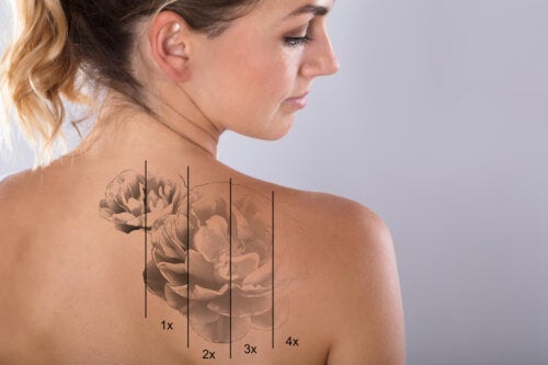 Wat zijn de risico's van een tatoeage weglaseren?