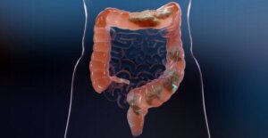 Colonhydrotherapie: mythes en feiten die je moet kennen