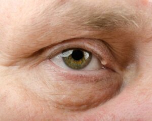 Hidrocystomen: wat het is, oorzaken en behandeling