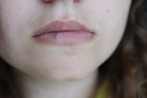 Lipkanker: oorzaken, symptomen en behandelingen
