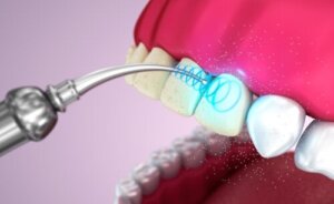 Ultrasone gebitsreiniging: de voor- en nadelen