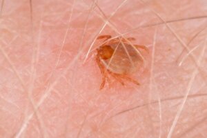 Rocky Mountain Spotted Fever: symptomen en behandelingen
