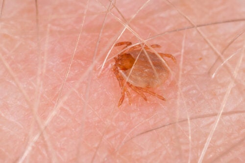 Rocky Mountain Spotted Fever: symptomen en behandelingen