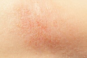 7 natuurlijke middelen voor een droge huid