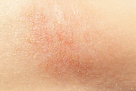 6 natuurlijke middelen voor een droge huid