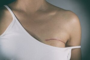 Soorten chirurgie bij de behandeling van borstkanker