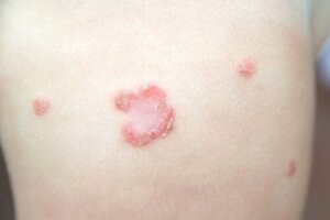 Impetigo bij kinderen
