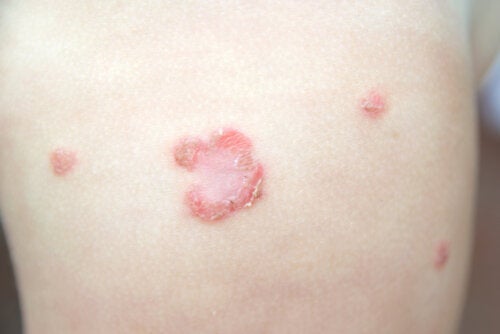 Impetigo bij kinderen