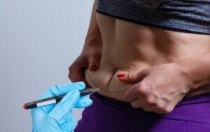 BodyTite, de technologie om lichaamszwakte te verminderen