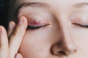 Een chalazion: alles wat je moet weten