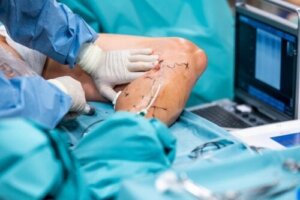 Endolaserchirurgie voor spataderen: wat is het en wat zijn de voordelen?