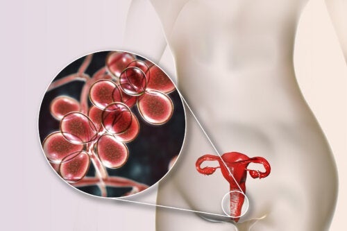 Gele vaginale afscheiding: 5 oorzaken en behandeling